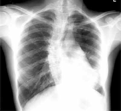akciğer röntgeni ve tedavisi