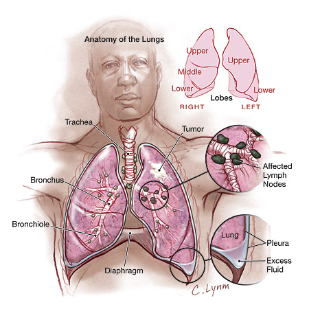 akciğer kanserinin yeri