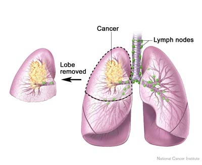 akciğer kanseri tedavisi belirtileri