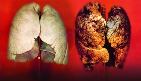 kanserli akciğer