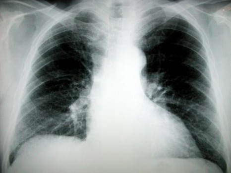 Akciğer kanseri sinsi ilerliyor
