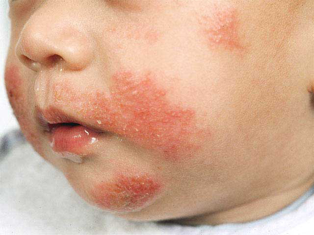bebeklerde alerji