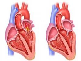 Kalp kapakçığı neden çürür?